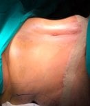 Résultat d'abdominoplastie et liposuccion chez Turan Turan Health Group, ventre plat
