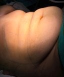Zone abdominale avant abdominoplastie et liposuccion chez Turan Turan Health Group, vue pré-op
