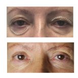 Before and after lower eyelid blepharoplasty results at Klinika La Perla, eye rejuvenation