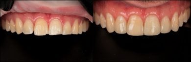 Antes y después de relleno estético compuesto en RIKOTA Dental Clinic, mejora de la sonrisa