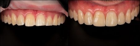 Antes y después de relleno estético compuesto en RIKOTA Dental Clinic, mejora de la sonrisa