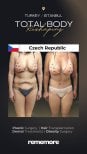 Before and after post-bariatric plastic surgery results at Memorial Şişli Hospital, body contouring