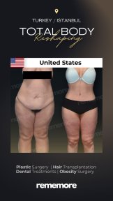 Before and after post-bariatric plastic surgery results at Memorial Şişli Hospital, body contouring