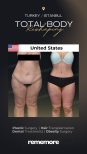 Before and after post-bariatric plastic surgery results at Memorial Şişli Hospital, body contouring