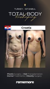 Before and after post-bariatric plastic surgery results at Memorial Şişli Hospital, body contouring