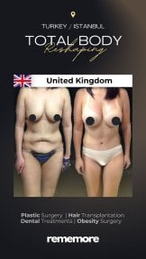 Before and after post-bariatric plastic surgery results at Memorial Şişli Hospital, body contouring