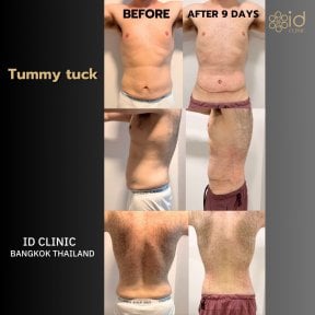 Результати до і після абдомінопластики в ID Clinic Bangkok, покращення контуру живота
