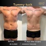 Результати до і після абдомінопластики в ID Clinic Bangkok, плаский живіт за 14 днів