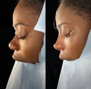 Résultats avant et après rhinoplastie à Lokman Hekim Istanbul Hospital, profil du nez amélioré