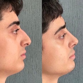 Résultats avant et après rhinoplastie à Lokman Hekim Istanbul Hospital, profil du nez amélioré