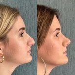 Before and after rhinoplasty results at Lokman Hekim Istanbul Hospital, nose reshaping