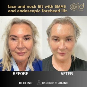 before-after photo tightening-of-facial-skin-facelift