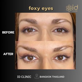 before-after photo tightening-of-facial-skin-facelift