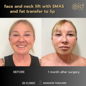 before-after photo tightening-of-facial-skin-facelift