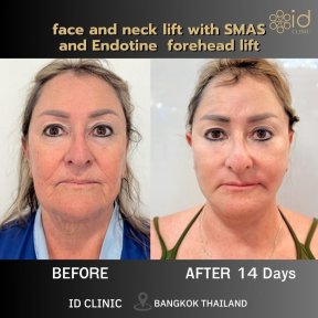 before-after photo tightening-of-facial-skin-facelift