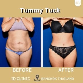 before-after photo abdominoplasty