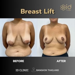before-after photo abdominoplasty