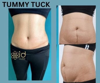before-after photo abdominoplasty