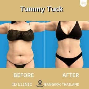 before-after photo abdominoplasty