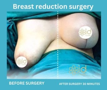 before-after photo abdominoplasty