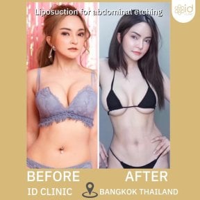before-after photo liposuction-2-3-body-areas
