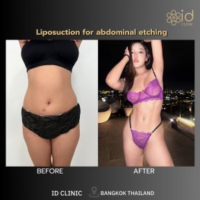 before-after photo liposuction-2-3-body-areas