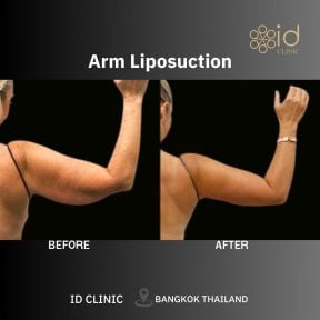 before-after photo liposuction-2-3-body-areas