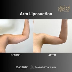 before-after photo liposuction-2-3-body-areas
