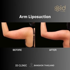 before-after photo liposuction-2-3-body-areas