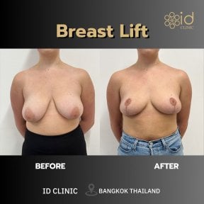 before-after photo liposuction-2-3-body-areas