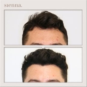 before-after photo fue-hair-transplant