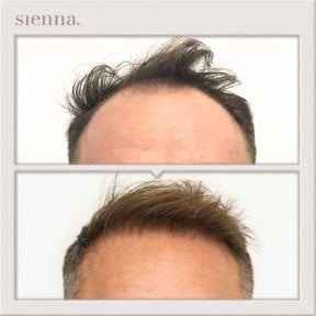 before-after photo fue-hair-transplant