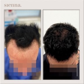 before-after photo fue-hair-transplant