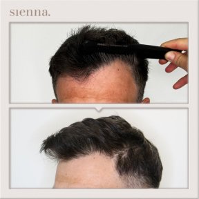 before-after photo fue-hair-transplant