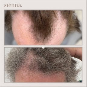 before-after photo fue-hair-transplant