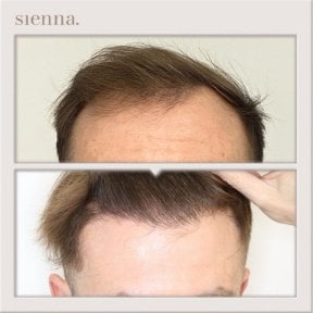 before-after photo fue-hair-transplant