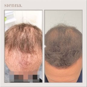 before-after photo fue-hair-transplant