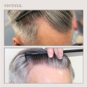 before-after photo fue-hair-transplant
