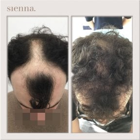 before-after photo fue-hair-transplant