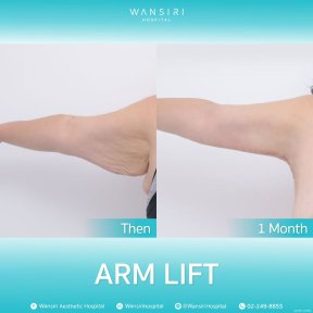 before-after photo breast-augmentation