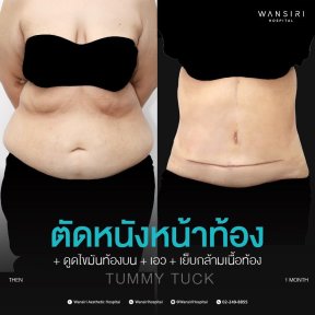 before-after photo breast-augmentation