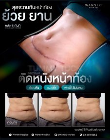 before-after photo breast-augmentation