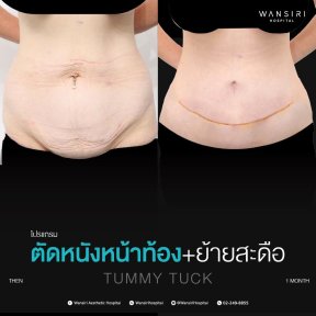 before-after photo breast-augmentation