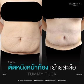before-after photo breast-augmentation