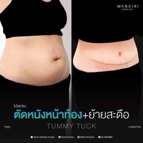 before-after photo breast-augmentation
