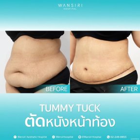 before-after photo breast-augmentation