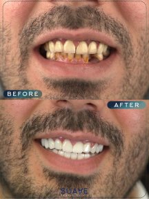 before-after photo zirconia-crown-installation