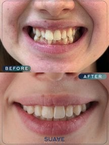 before-after photo invisalign