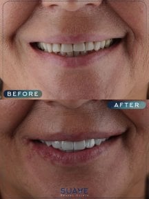 before-after photo invisalign