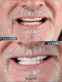 before-after photo invisalign